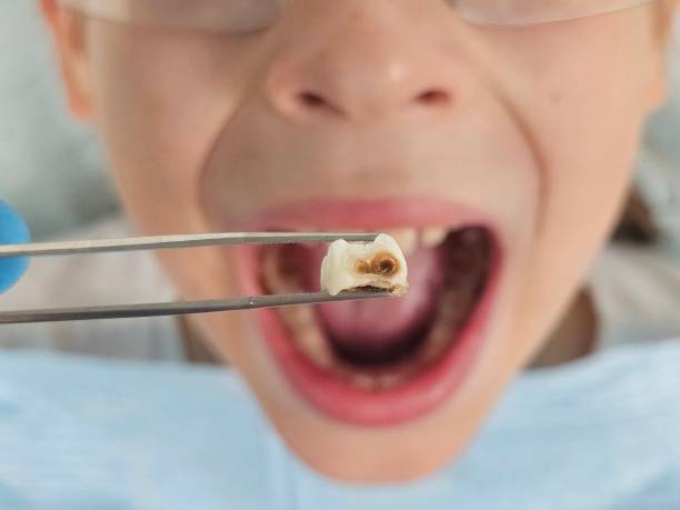 Best Emergency Dentist for Lost Fillings or Crowns in Uniontown, OH